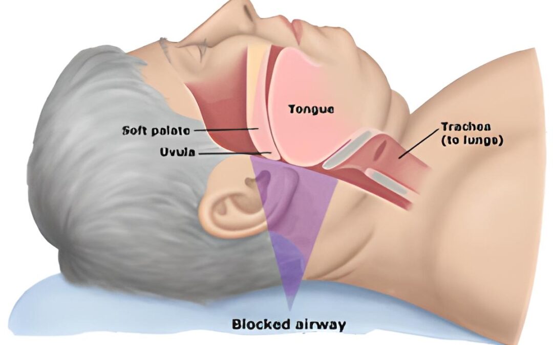 Disturbi respiratori del sonno