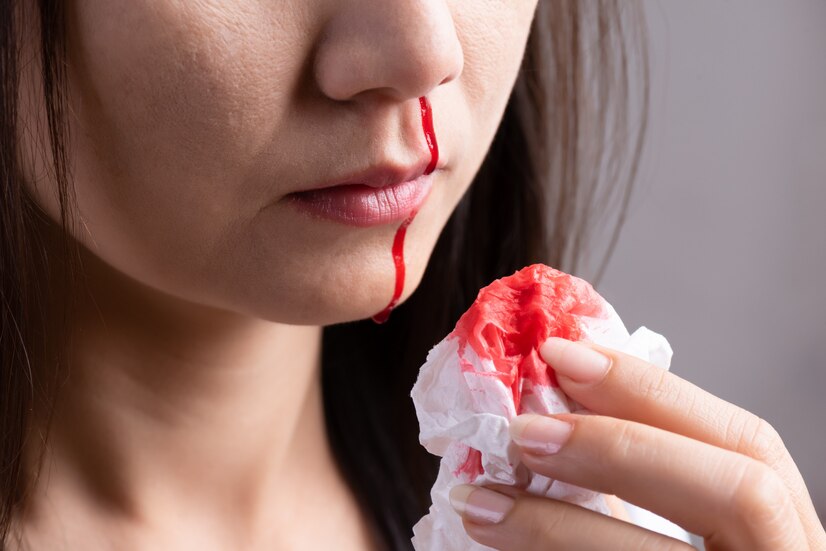 La perdita di sangue dal naso (anche epistassi o rinorragia) è una manifestazione che può verificarsi a tutte le età, ma è molto più frequente nei bambini. Nella foto, una donna che tampona il sangue dal naso con un fazzoletto.