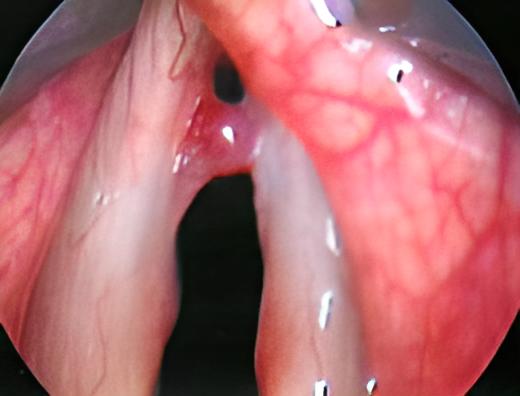 Un'immagine di corde vocali affette da polipi.
