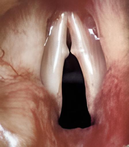 Noduli delle corde vocali