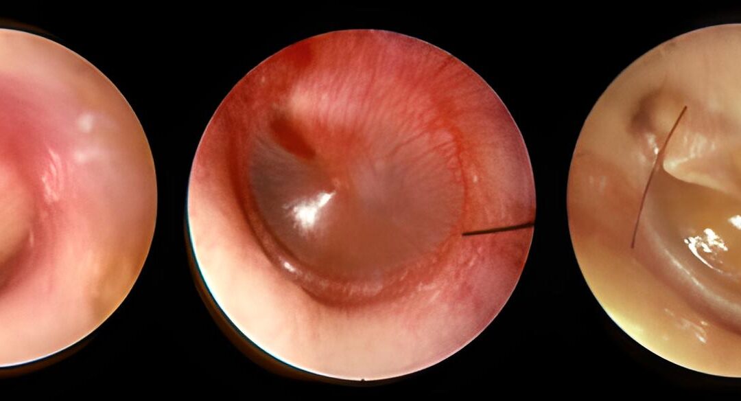 L'immagine di un orecchio affetto da otite media acuta