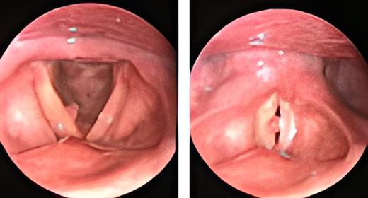 L'immagine di corde vocali affette da polipi.