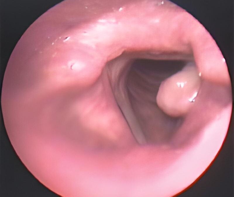 L'immagine mostra il referto medico di granulomi alle corde vocali.
