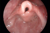 La laringomalacia è una patologia congenita della laringe del neonato e rappresenta da sola circa il 70% dei problemi laringei nella età pediatrica.