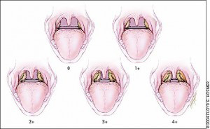 Le tonsille
