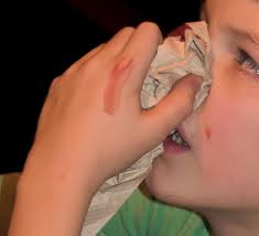 L'epistassi nel bambino è abbastanza comune, ma non bisogna troppo allarmarsi. L'importante è sapere come agire. Nella foto, un bambino che si tampona il naso sanguinante.