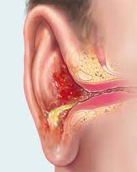 Il sintomo più importante dell'otite esterna è certamente il dolore all'orecchio spesso molto intenso. Nella foto un orecchio affetto da orite.