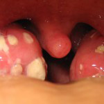 Nella faringotonsillite acuta la faringe appare iperemica e le tonsille palatine appaiono edematose e arrossate, spesso ricoperte da essudato follicolare biancastro. Vi è spesso associata una adenopatia laterocervicale bilaterale
