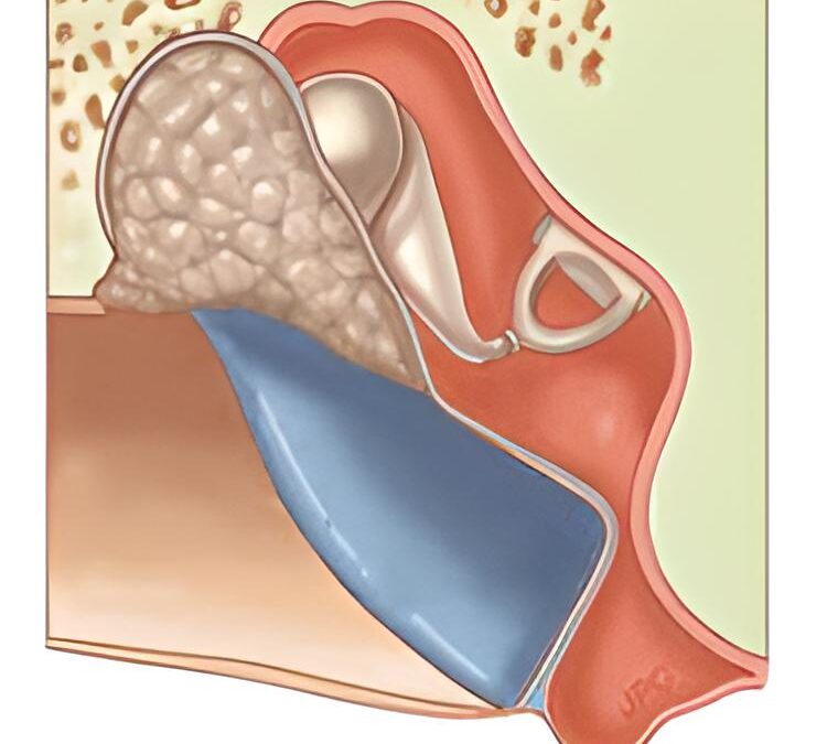 Colesteatoma