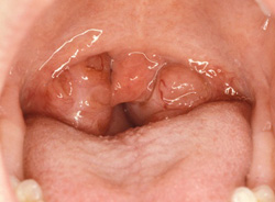 L’ipertrofia tonsillare rappresenta l’indicazione più frequente per l’intervento di tonsillectomia nei bambini. L’iperplasia semplice non è una malattia, ma solo una evidenza di una attività immunologica aumentata. Nella foto, si vedono tonsille infiammate.