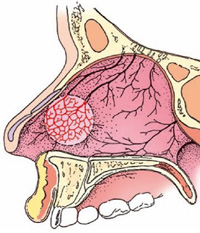 Gli episodi di epistassi sono abbastanza comuni nel bambino. La parte anteriore del naso contiene molti vasi sanguigni fragili che possono essere danneggiati facilmente. Nella foto, il grafico di un naso.