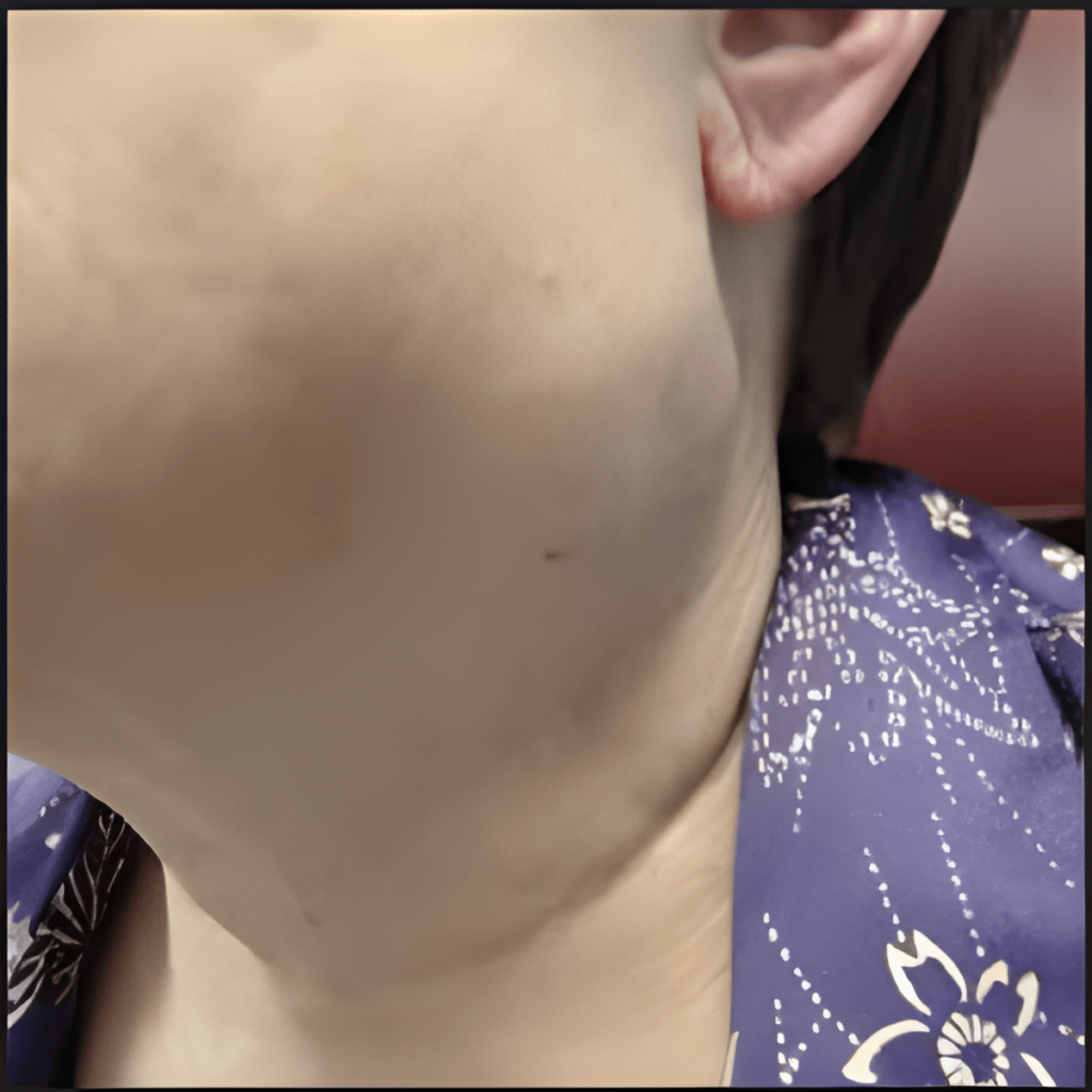 I tumori delle ghiandole salivari si presentano con una tumefazione senza sintomi importanti a crescita lenta. Nella foto, un paziente che presenta una tumefazione al collo.