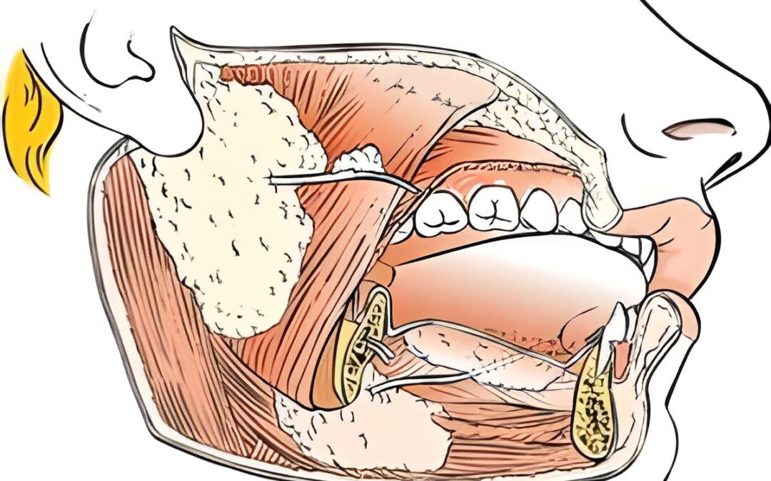 Le neoplasie delle ghiandole salivari interessano prevalentemente la parotide, meno la ghiandola sottomandibolare, ancor meno le altre. La forma più frequente è il cosiddetto tumore misto o adenoma pleomorfo. Nella foto, un grafico che rappresenta la paerotide.