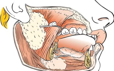 Patologia neoplastica delle ghiandole salivari
