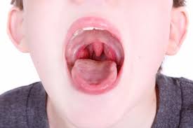 La Tonsillite nel bambino e la Febbre Reumatica da Streptococco