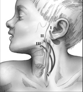 Cisti e fistole laterocervicali rientrano fra le principali forme di tumefazioni al collo del bambino. Le anomalie di sviluppo embrionale del II, III e IV arco branchiale si possono manifestare con la presenza di cisti con contenuto liquido o con la evidenza di fistole drenanti a livello del margine anteriore del muscolo sternocleidomastoideo o nel caso di anomalie del I arco branchiale in sede sottomandibolare o preauricolare. Nella foto, un diagramma che rappresenta cisti e fistole laterocervicali.