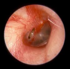 In quali casi è necessario operare con una chirurgia dell'orecchio medio? Con il termine di Otite Media Cronica (OMC ) indichiamo una condizione patologica dell’orecchio medio e della mastoide che coincide con la presenza di una perforazione timpanica. Rappresenta  spesso un esito di otiti medie acute recidivanti o di un evento traumatico. E' caratterizzata dalla presenza di una  perforazione della membrana timpanica che pone in diretto contatto la cavità dell'orecchio con l’ambiente esterno aprendo in tal modo una nuova porta d’ingresso dei germi. Nella foto, l'interno di un orecchio affetto da infezione.