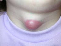 Fra le tumefazioni al collo del bambino, le più diffuse sono le cisti del dotto tireoglosso. Queste si originano da residui embrionali del dotto tireoglosso e possono contenere al suo interno tessuto tiroideo. Nella foto il collo di un bambino affetto da cisti del dotto tireoglosso.